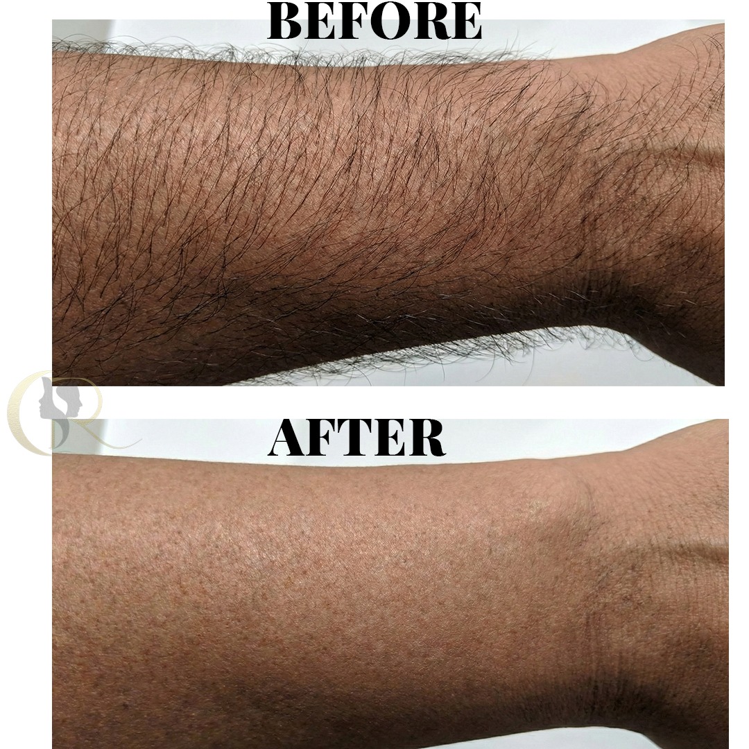 Cosmo Radiance result: Full Arms Reduction